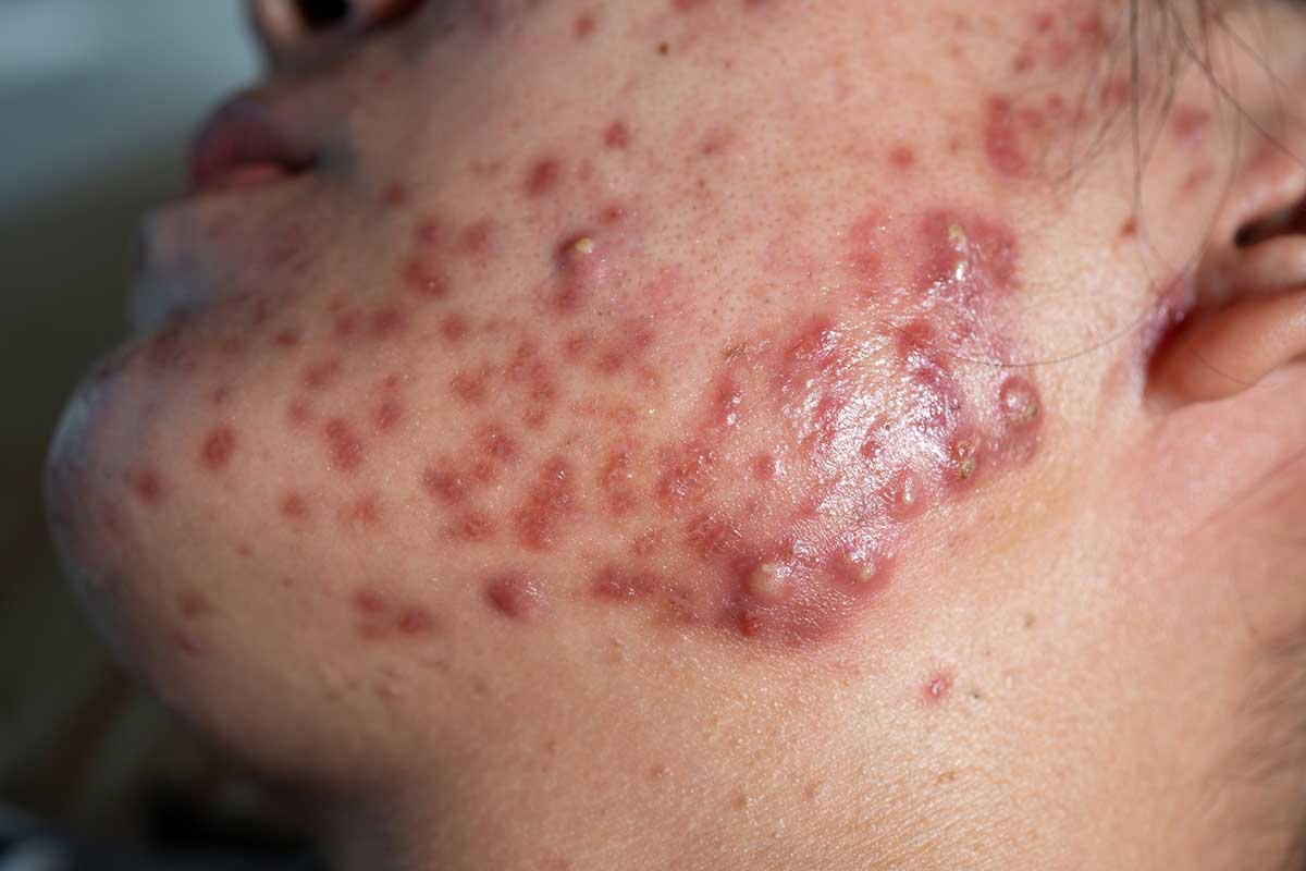 Skaityti daugiau apie straipsnį Acne and pimples – unpleasant companions